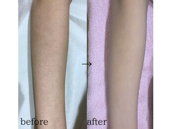 スパイリーア(Spiraea)/脱毛BeforeAfter