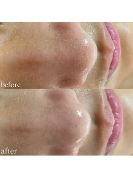 ダオン(Daon)/毛穴洗浄