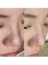 アネモネ(ANEMONE)/韓国式3D毛穴洗浄