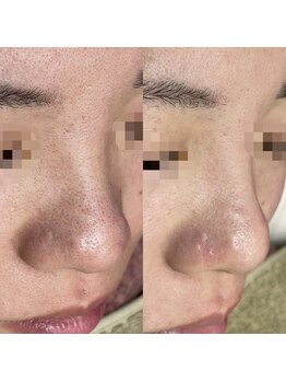 アネモネ(ANEMONE)/韓国式3D毛穴洗浄