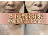 【肌質改善】シミ・毛穴・くすみ改善☆ノーファンデ美肌へ