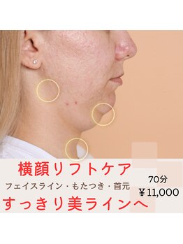 ミモザ(mimosa)/横顔リフト◎すっきり美ライン