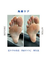 ピーアンドオー(P&O)/角質ケア