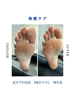ピーアンドオー(P&O)/角質ケア