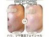 ハリツヤ復活★水素洗浄or毛穴エクストラクション＋ヒト幹ポレーション/通常