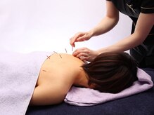 シー バイ カリスタ 池袋店(C by CALISTA)/うつ伏せ鍼で肩こりをすっきり