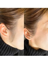 チュルリ 新町店(Chururi)/もみあげ/もみあげワックス脱毛