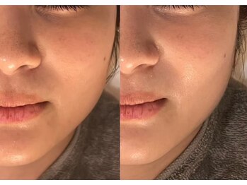 リスタ(RSTA)/【BEFORE/AFTER】