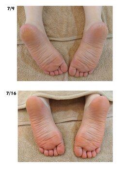 ナチュラルハリー(NaturalHarry)/【足ツボbefore→after】