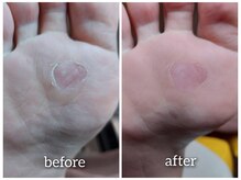 爪切り屋 足楽/魚の目と「スピール膏」