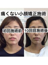 オズ六本木/東京六本木の痛く無い小顔矯正