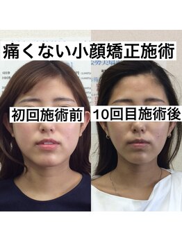 オズ六本木/東京六本木の痛く無い小顔矯正