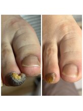 ドクターネイル爪革命 十条店/肥厚爪ケア