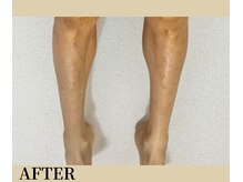 リノ(Lino)/1回の脱毛の効果