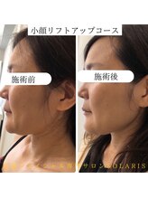ソラリス(solaris)/小顔リフトアップコース