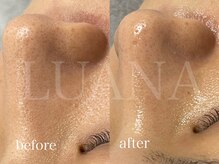 ルアナ(LUANA)/毛穴洗浄