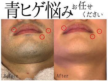 スポット 薬院駅前店(SPOT)/剃り負け青ヒゲ悩みならヒゲ脱毛