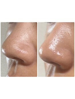 毛穴ケアをしたい