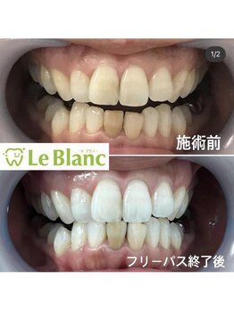 ルブラン 奈良店(Le Blanc)/白くするならフリーパス