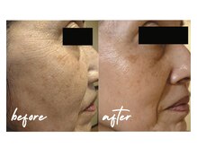 private salon Soame/うるツヤ水光肌☆PHA水光ピール