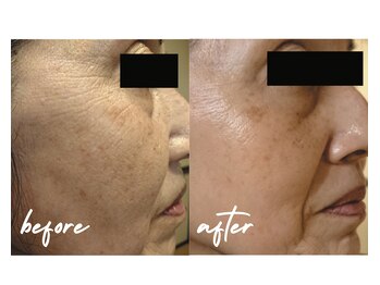 private salon Soame/うるツヤ水光肌☆PHA水光ピール