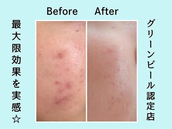 カノン(KANON)/グリーンピール