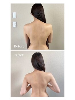 ラースパアザブ 札幌円山(La SPA azabu)/ボディ施術ビフォーアフター