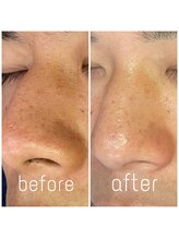 サラモ(Sa La Mo)/毛穴ケア＆毛穴洗浄+黒ずみ毛穴