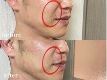 エピリス(Epiliss)/ほうれい線ビフォーアフター