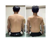 リンクの雰囲気（初回1回のビフォーアフターです♪脂肪ではなくむくみでした♪）