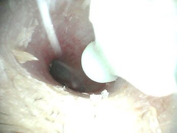 イヤースコープサロン叶 新宿店/施術前