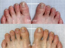 ニーヨンゼロ(240)/巻き爪・タコ・ウオノメ再発予防