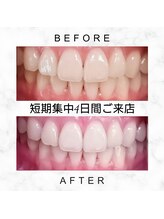 エミリアホワイトニング(EMIRIA WHITENING)/Before/After
