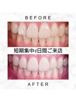 エミリアホワイトニング(EMIRIA WHITENING)/Before/After