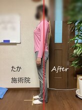 たか施術院/美姿勢矯正 10代 2回目