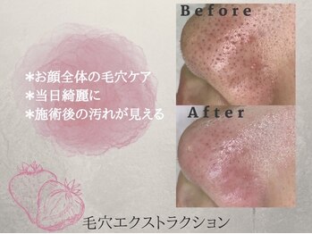 ダブル(W)/毛穴エクストラクションtete式