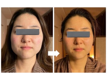 スリーピングビューティー(Sleeping Beauty)/インディバ　小顔リフト