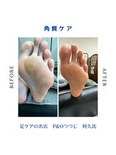 ピーアンドオー(P&O)/角質ケア