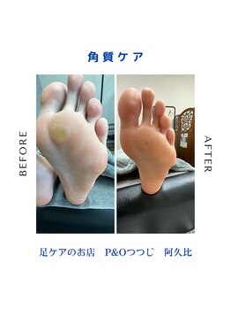 ピーアンドオー(P&O)/角質ケア