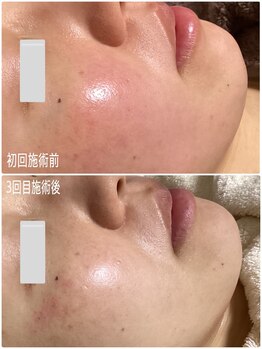 ブライトリー(Brightly)/最新光エステでシミ肌質改善!