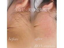 サロンロンウーマン(SALON RON woman)/うなじ脱毛/全身脱毛