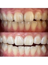 ワールドビューティー(World Beauty)/プレミアムホワイトニング