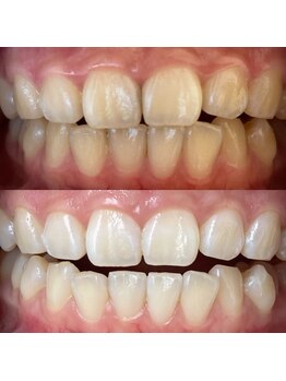 ワールドビューティー(World Beauty)/プレミアムホワイトニング