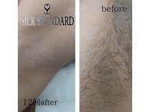 シルクスタンダード(SILK STANDARD)/脇脱毛before&after