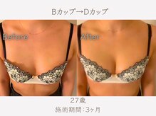 ハリスタ 天王寺院(HARISTA)/3ヶ月間でBカップ→Dカップ