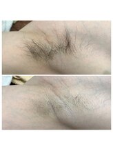 ランプ(LAMP)/～メンズワキ脱毛～