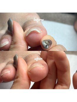 ネイルサロン ユーズ(USE.)/巻き爪ケア/フットケア