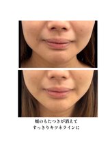 プレジール(PLAISIR)/レモンボトル　Before・After