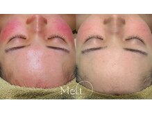 メルト 中目黒(Melt.)/＊厳選国産ハーブピーリング