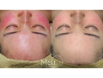 メルト 中目黒(Melt.)/*厳選国産ハーブピーリング